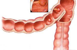 结肠癌是什么原因引起,遗传、饮食与生活方式的关联